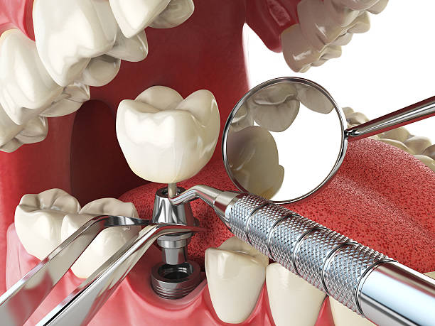 Best Emergency Root Canal Treatment in Lockhart, TX